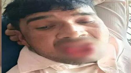 வலுக்கட்டாயமாக முத்தம் கொடுத்தவரின் உதட்டைக் கடித்துத் துப்பிய காதலி!